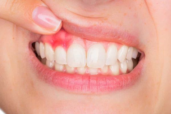 10 Tanda Awal Penyakit Gusi yang Harus Kamu Waspadai 10 Tanda Awal Penyakit Gusi yang Harus Kamu Waspadai