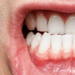 10 Jenis Penyakit Gusi dan Cara Menghindarinya
