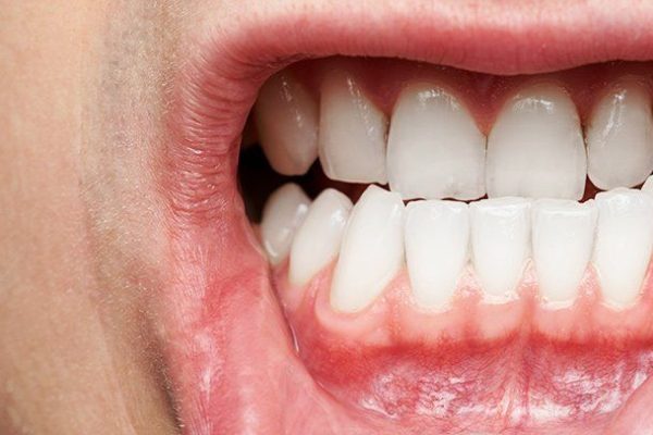 10 Jenis Penyakit Gusi dan Cara Menghindarinya 10 Jenis Penyakit Gusi dan Cara Menghindarinya