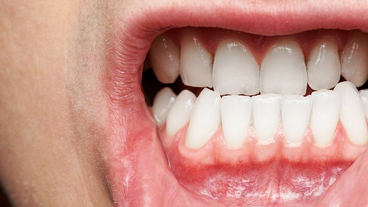 10 Jenis Penyakit Gusi dan Cara Menghindarinya