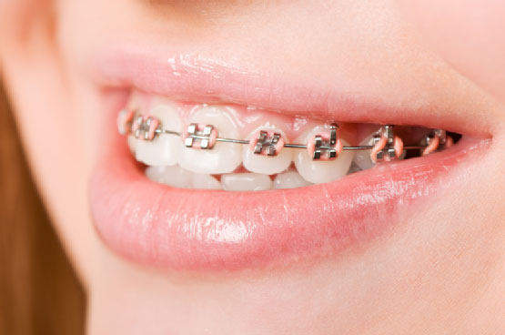 7 Tips Merawat Bibir Sehat Buat Kamu yang Pakai Behel