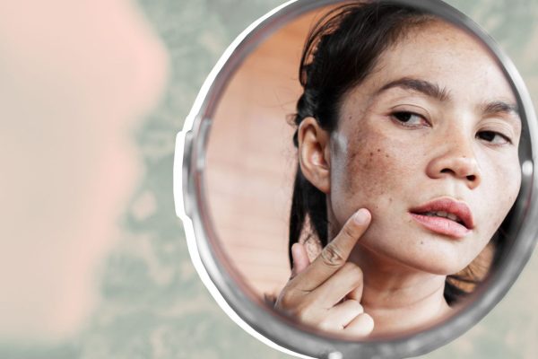 10 Cara Alami Menghilangkan Bintik Hitam di Dagu 10 Cara Alami Menghilangkan Bintik Hitam di Dagu